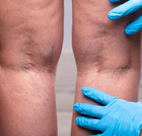 How To Get Rid Of Varicose Veins With Radiofrequency Venous Ablation