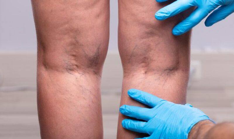 o How To Get Rid Of Varicose Veins With Radiofrequency Venous Ablation