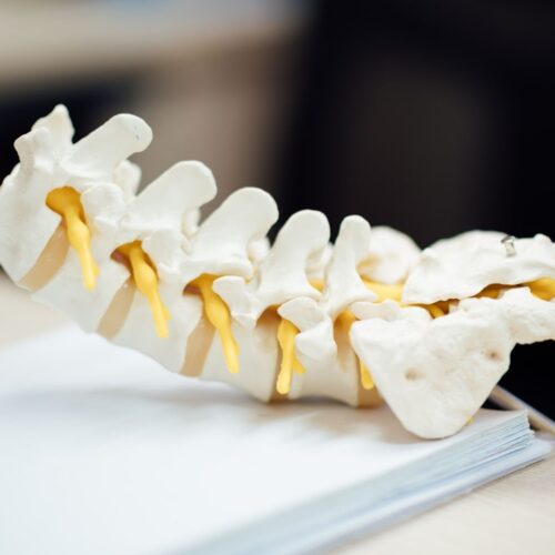 Hadi Kyphoplasty Benefits of Kyphoplasty for Spinal Fractures