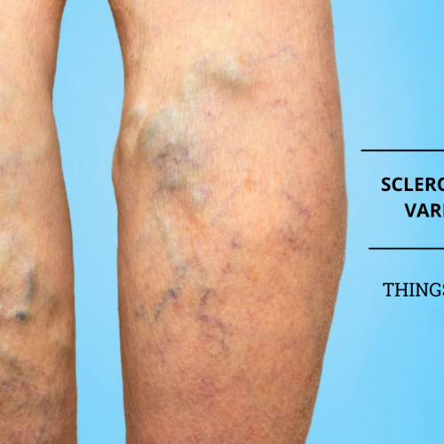 Sclerotherapy What To Expect from Sclerotherapy for Varicose Veins