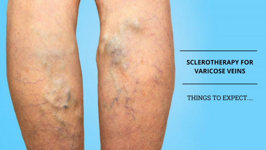 Sclerotherapy What To Expect from Sclerotherapy for Varicose Veins