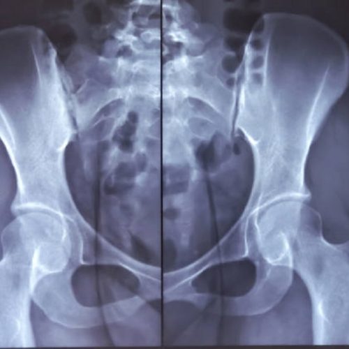 image44 Sacroiliac Joint Injections for Low Back Pain in Long Beach and Plainview, NY
