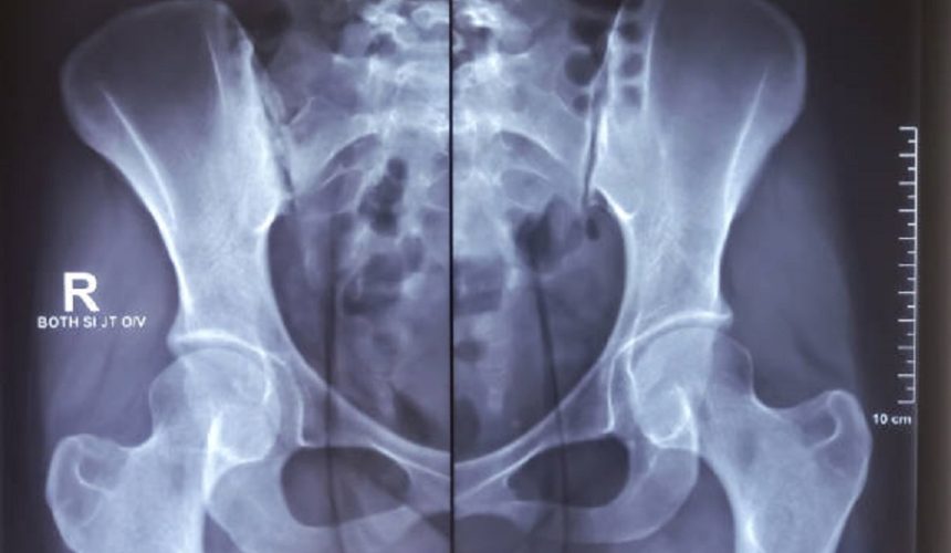 image44 Sacroiliac Joint Injections for Low Back Pain in Long Beach and Plainview, NY