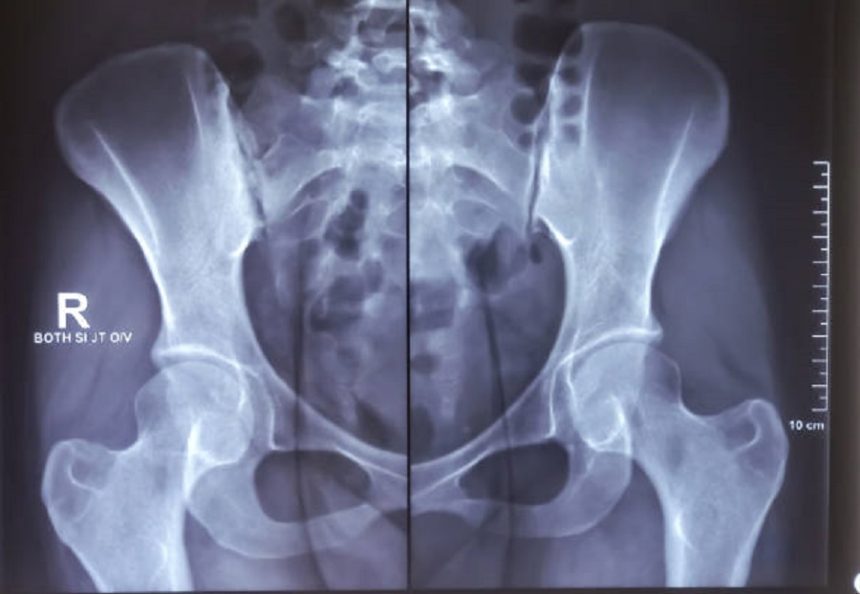image44 Sacroiliac Joint Injections for Low Back Pain in Long Beach and Plainview, NY