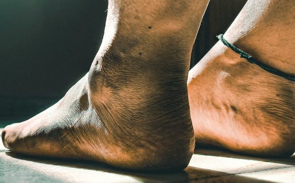 Blood Pooling: What Causes It and How Is It Treated?